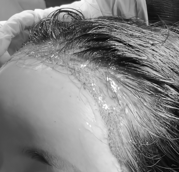 EGFケアですばやいダメージケア