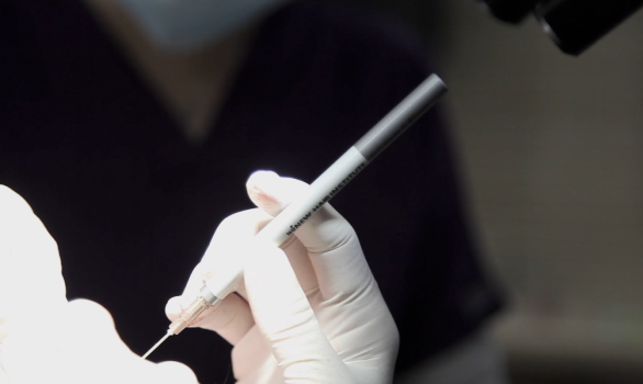 頭皮の損傷が少ない最小侵襲の毛髪移植