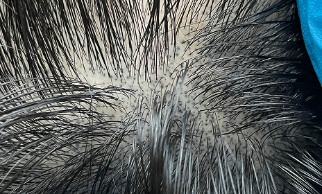 実際に髪の毛が生えてきたように
表現するニューヘアーだけのノウハウ