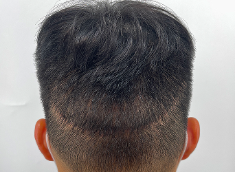 頭皮の傷跡