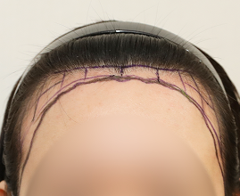 ヘアライン施術の写真