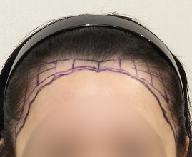 ヘアライン施術の写真