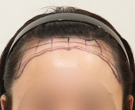 ヘアライン施術の写真