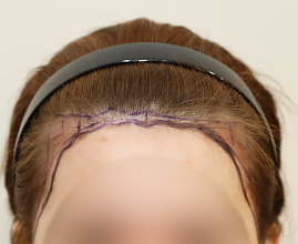 ヘアライン施術の写真