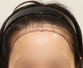 ヘアライン施術の写真