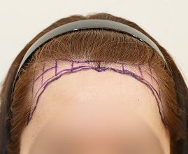 ヘアライン施術の写真