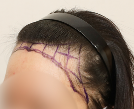 ヘアライン施術の写真