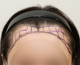 ヘアライン施術の写真