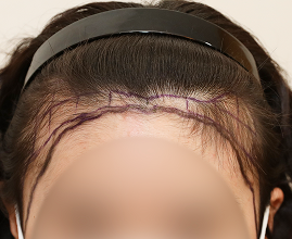 ヘアライン施術の写真