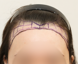 ヘアライン施術の写真