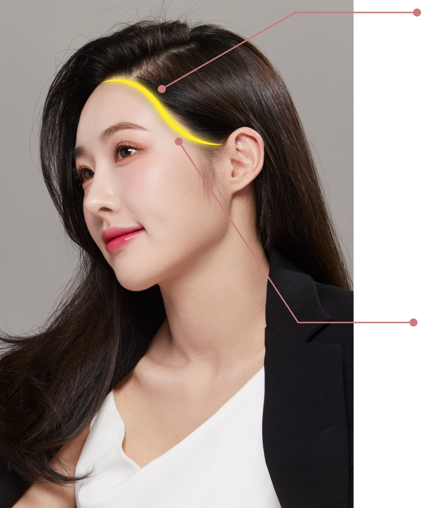 自然で立体的な顔のための**Sラインヘアーライン矯正**