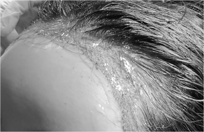 ヘアーライン矯正後使用するEGF成分のジェルと生着スプレーが傷跡の組織が早く綺麗に癒えるよう手助けし、赤みを早く解消し日常生活にすぐ復帰できます。