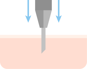 移植部位に毛穴を作る