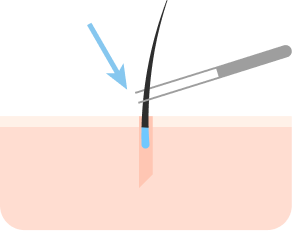 毛穴に移植毛嚢挿入