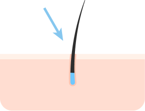 最小限の傷跡できれいな移植結果
