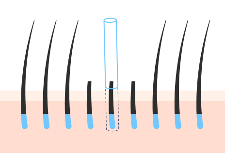 一般的な非切開