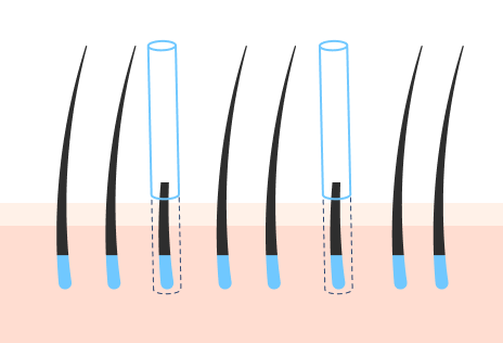 事前カット非切開