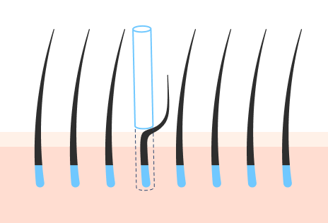 完全無剃毛非切開