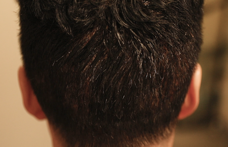 植毛翌日(シャンプー後)