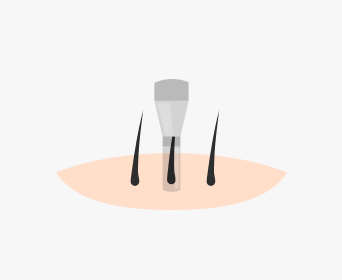 절개 헤어라인교정