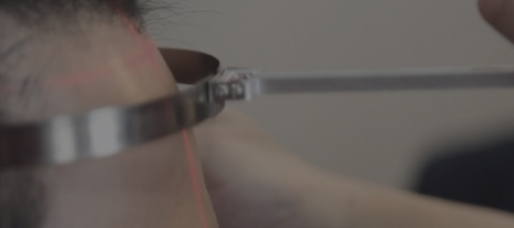 毛髪移植(ヘアライン矯正)